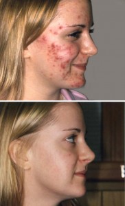Acne behandling i Odense