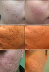 dermapen behandling af ar i Odense