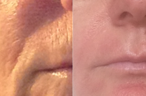 Behandling af rynker med kemisk peeling i Odense