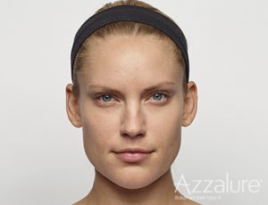Efter behandling med botox