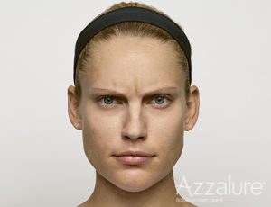 Botox behandling af rynker