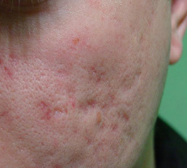 røde ar efter acne