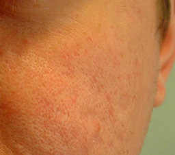 fjernelse af acne ar fjernelse af acne ar